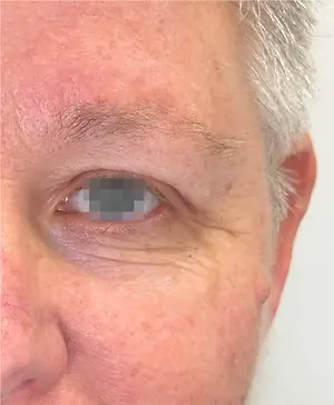 Close-up of an elderly person's face with a noticeable mole or birthmark on the lower eyelid.