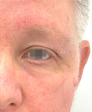 A close-up of a man's face with a red spot on his nose and a gray square covering his eye.