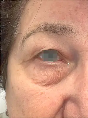 Close up of an elderly woman's eye showing signs of chalazion with redness and swelling around the eyelid.