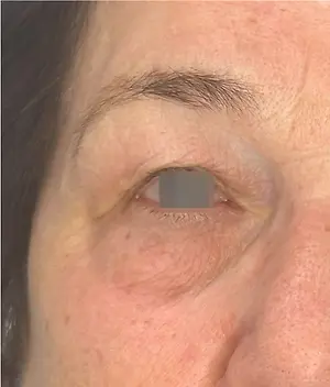 close up of a woman's face showing the crow's feet around her eye