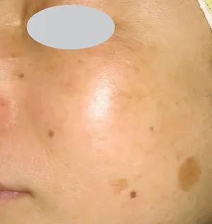Close up of a woman's face showing a variety of skin discolorations and freckles