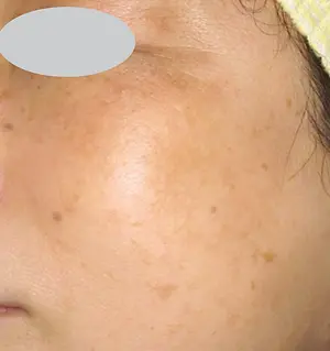 Close-up of a person's face showing skin with uneven pigmentation and freckles