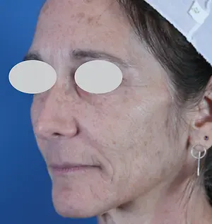 A close-up of an older woman's face with noticeable wrinkles and a white circle highlighting her eyes.