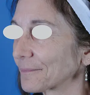 A close-up of a woman's face showing signs of aging with white circles over her eyes