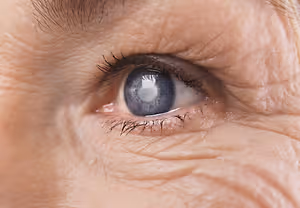 Close up of an elderly woman's eye with a cloudy lens.