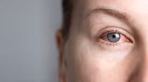 A close up of a woman's eye with a red spot and gray iris, she has brown hair and eyebrows and is looking at the camera.