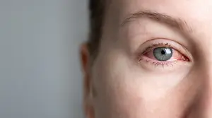 A close up of a woman's eye with a red spot and gray iris, she has brown hair and eyebrows and is looking at the camera.