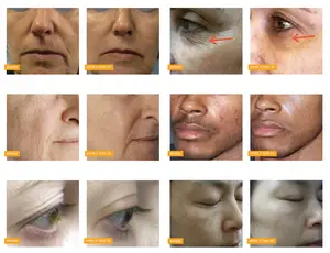 A series of before and after photos showcasing the effects of Tixel TX treatments on various facial areas, highlighting improvements in skin texture, reduction of fine lines, and overall rejuvenation.