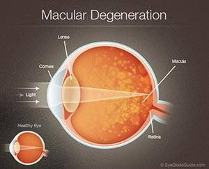 Macular Degeneration diagram showing cornea, lens, macula, and retina