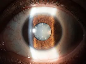 A close-up of a human eye with a clear iris and a visible pupil, showing details of the eye's structure and color.