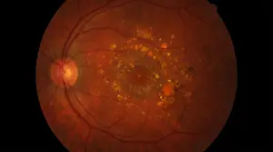 Color fundus photo showing retinal hemorrhages and yellowish exudates in the macula region
